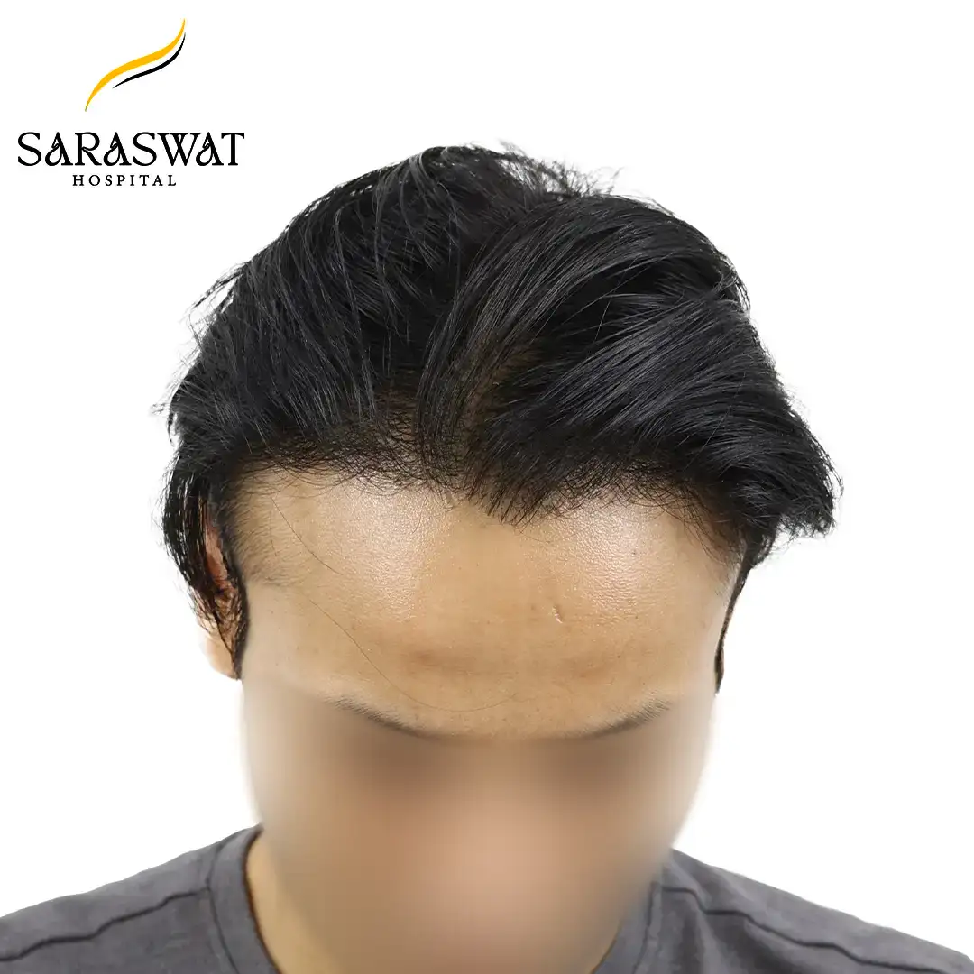 Top FUE Hair Transplant Result After Procedure