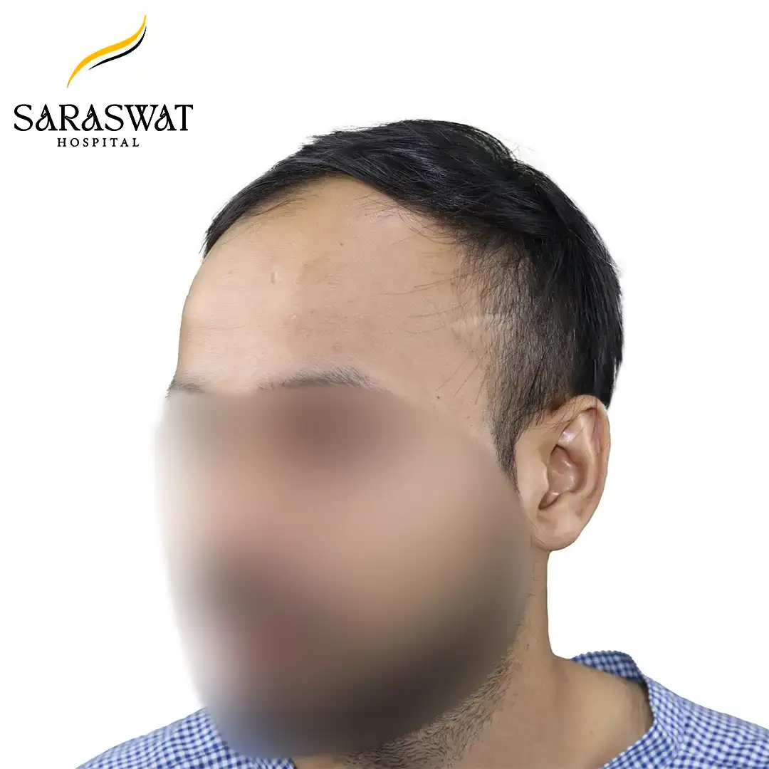 45 Degree Left FUE Hair Transplant Result Before Procedure