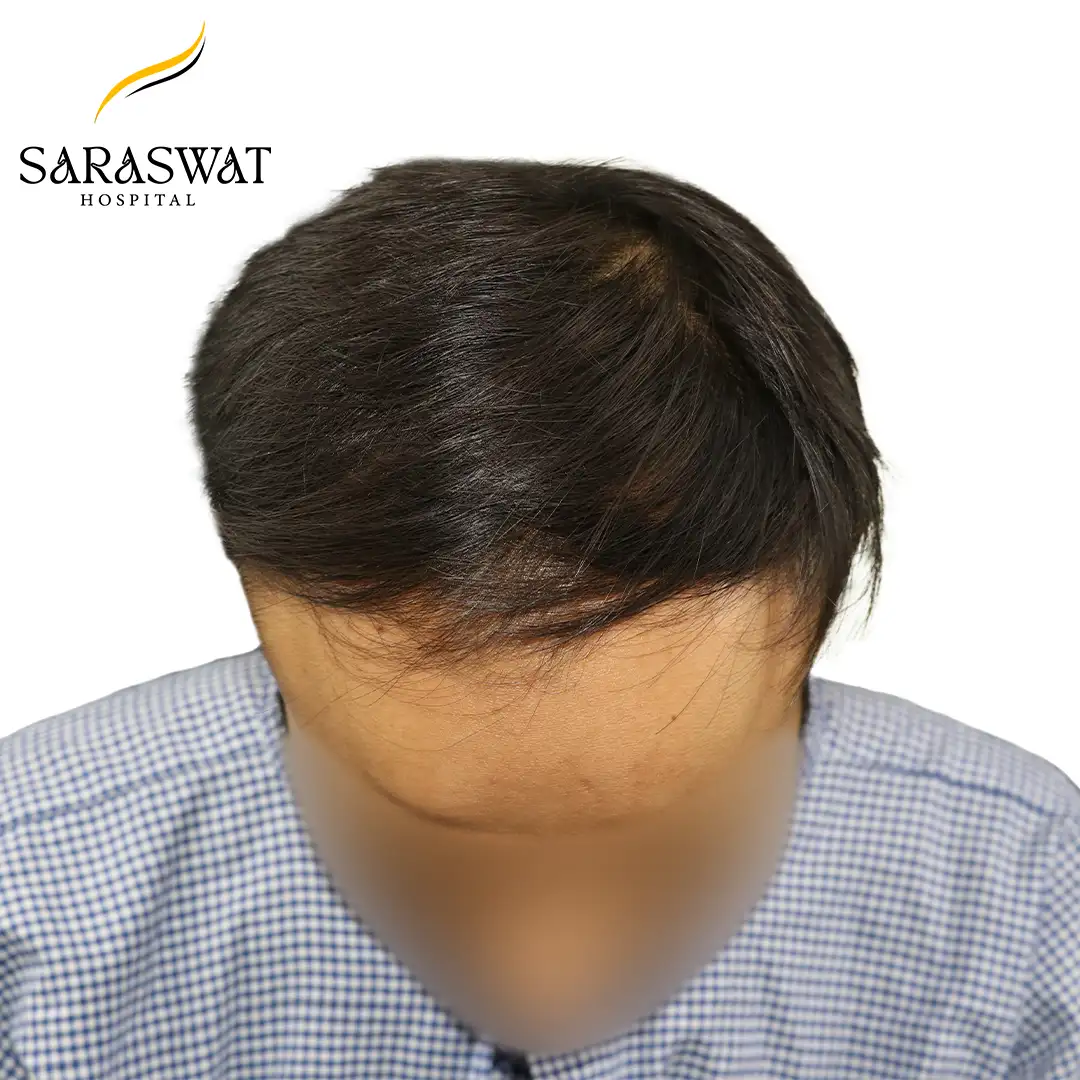 Top FUE Hair Transplant Result Before Procedure