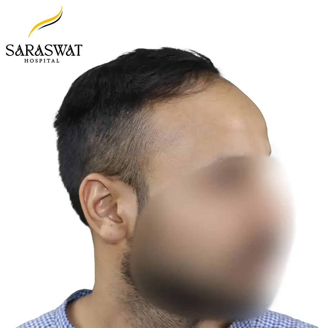 90 Degree Right FUE Hair Transplant Result Before Procedure
