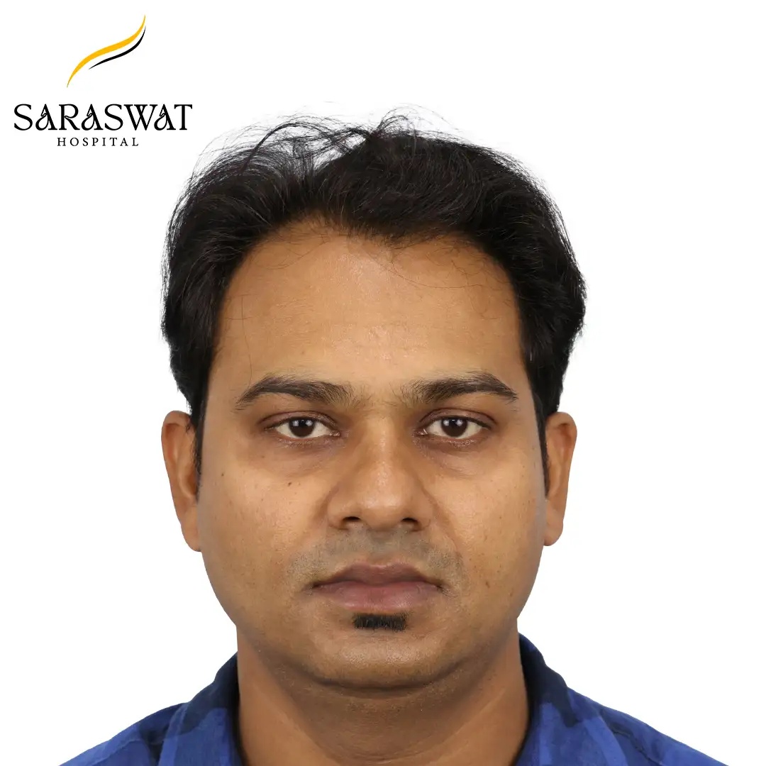 Hair Transplant Before and After Results