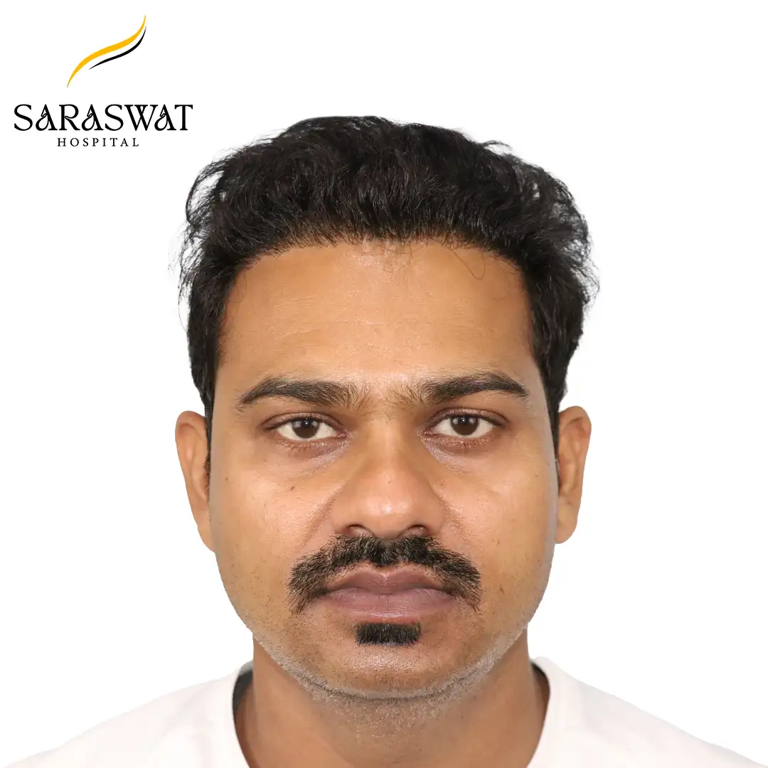 Hair Transplant Before and After Results