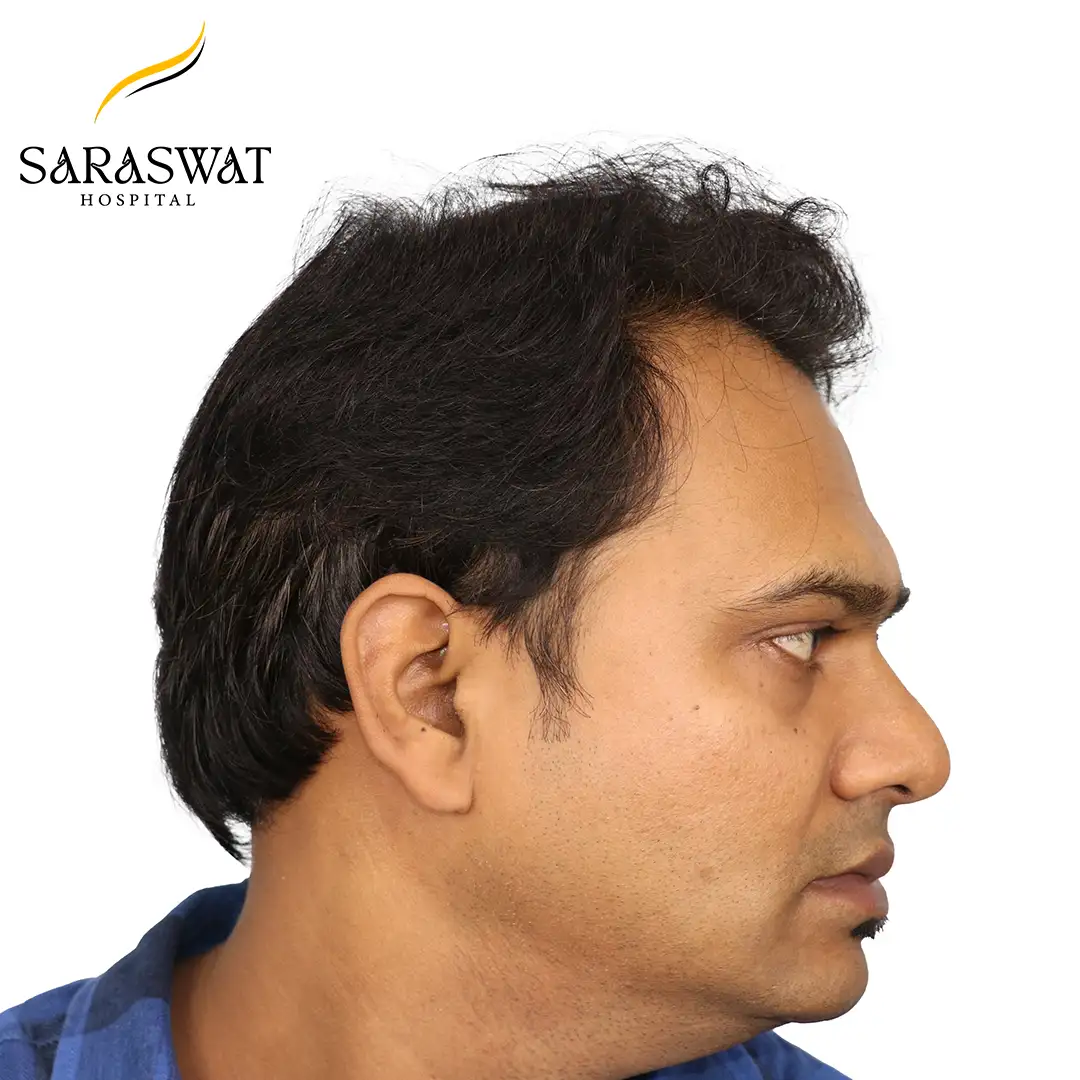 FUE Hair Transplant Before