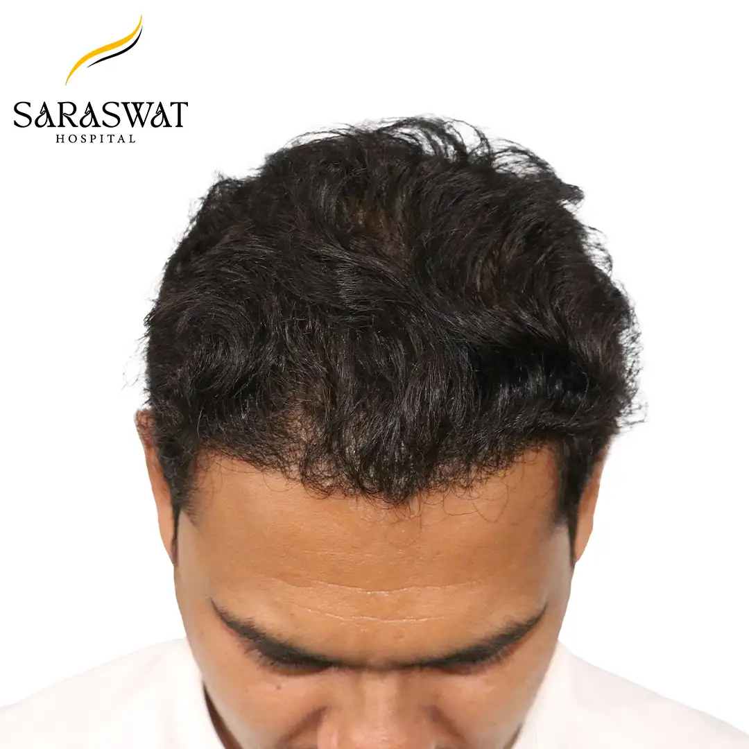 Hair Transplant Before After