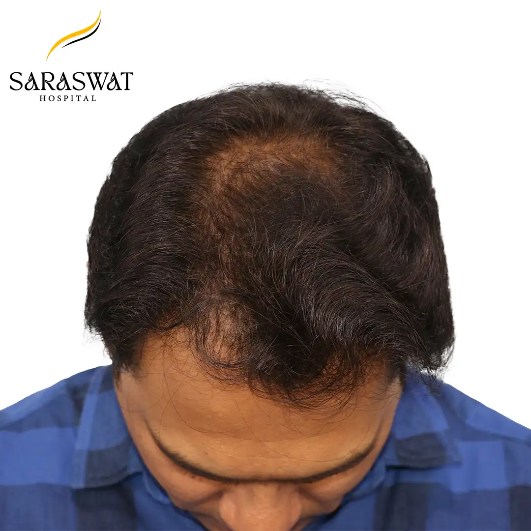 Hair Transplant Before After