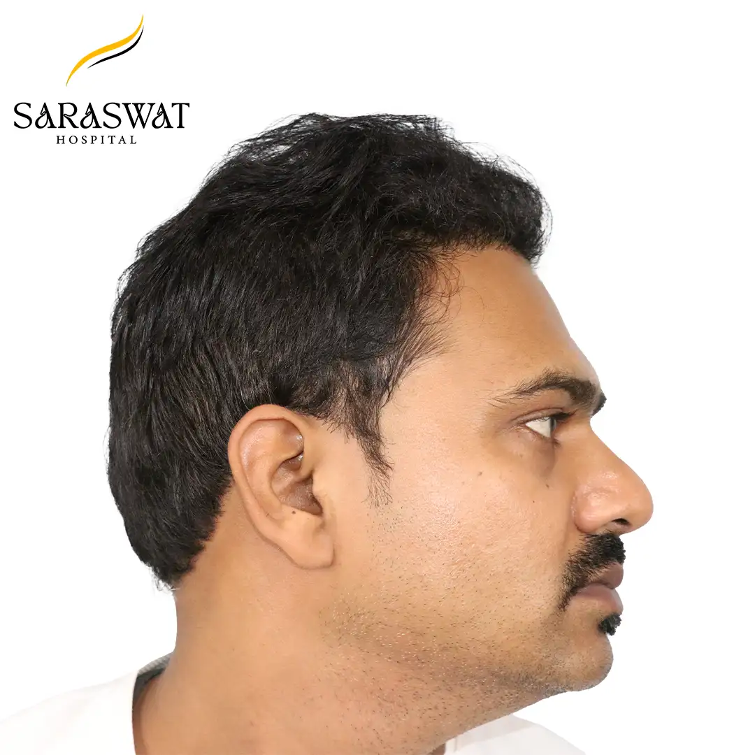 FUE Hair Transplant After