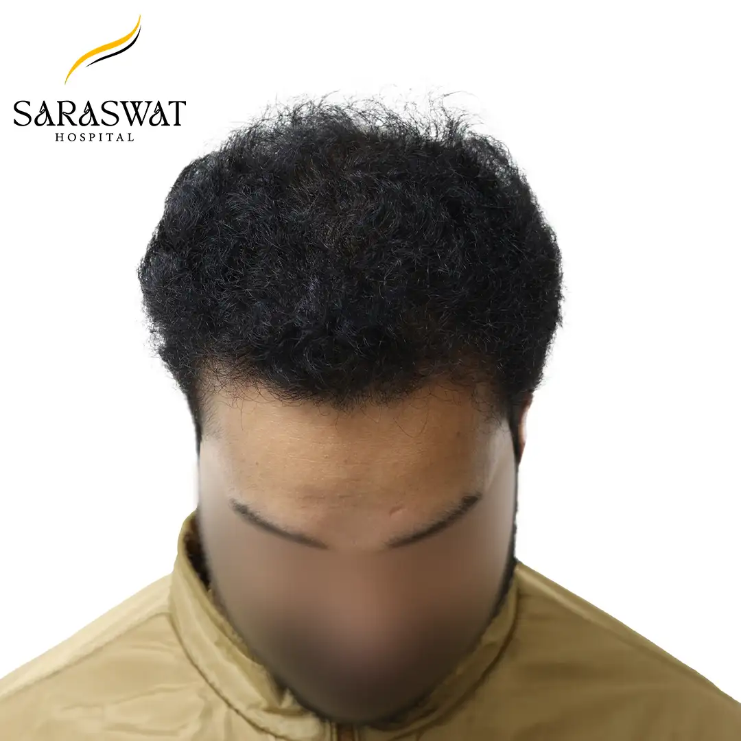 Top FUE Hair Transplant Result After Procedure