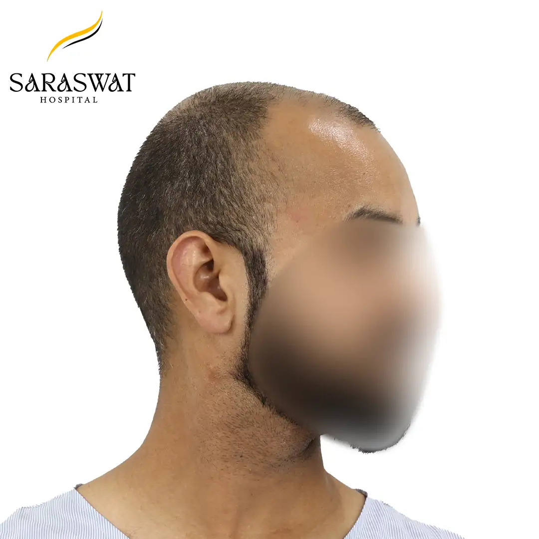 90 Degree FUE Hair Transplant Result Before Procedure