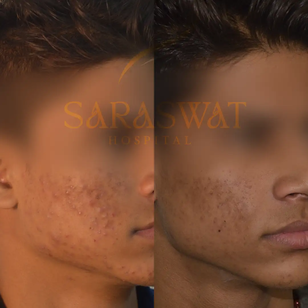 Acne Scar Treatment Results