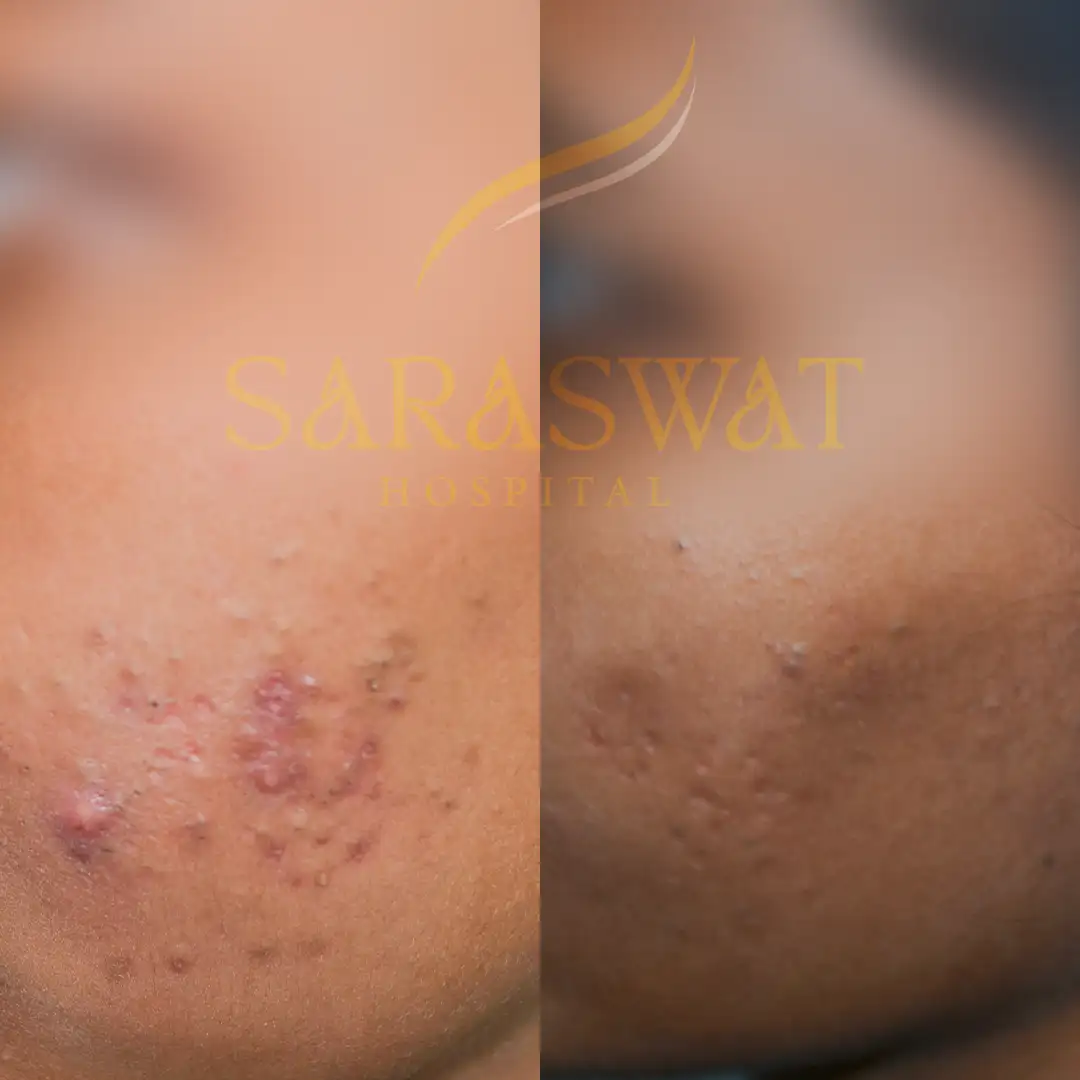 Acne Scar Treatment Results