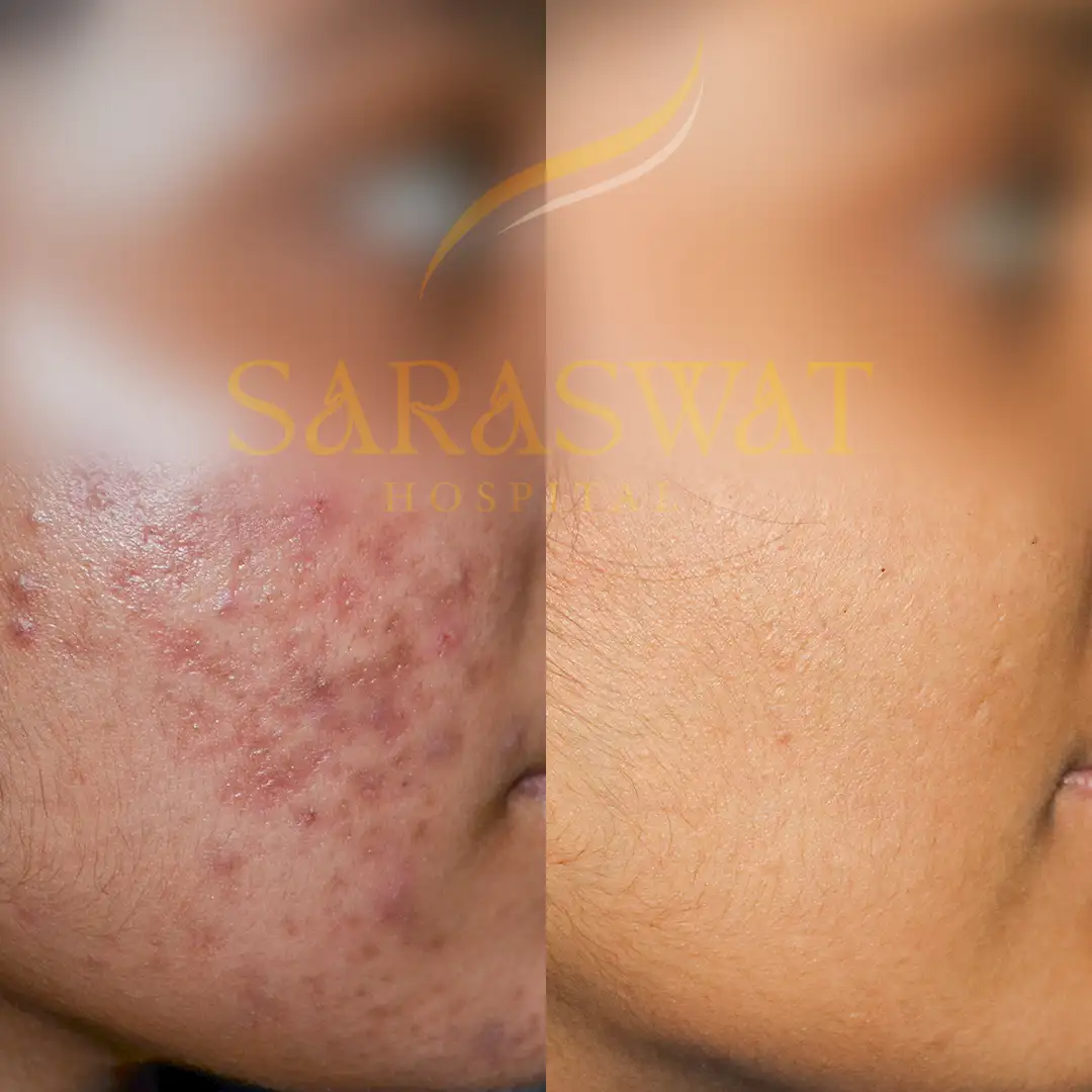 Acne Scar Treatment Results