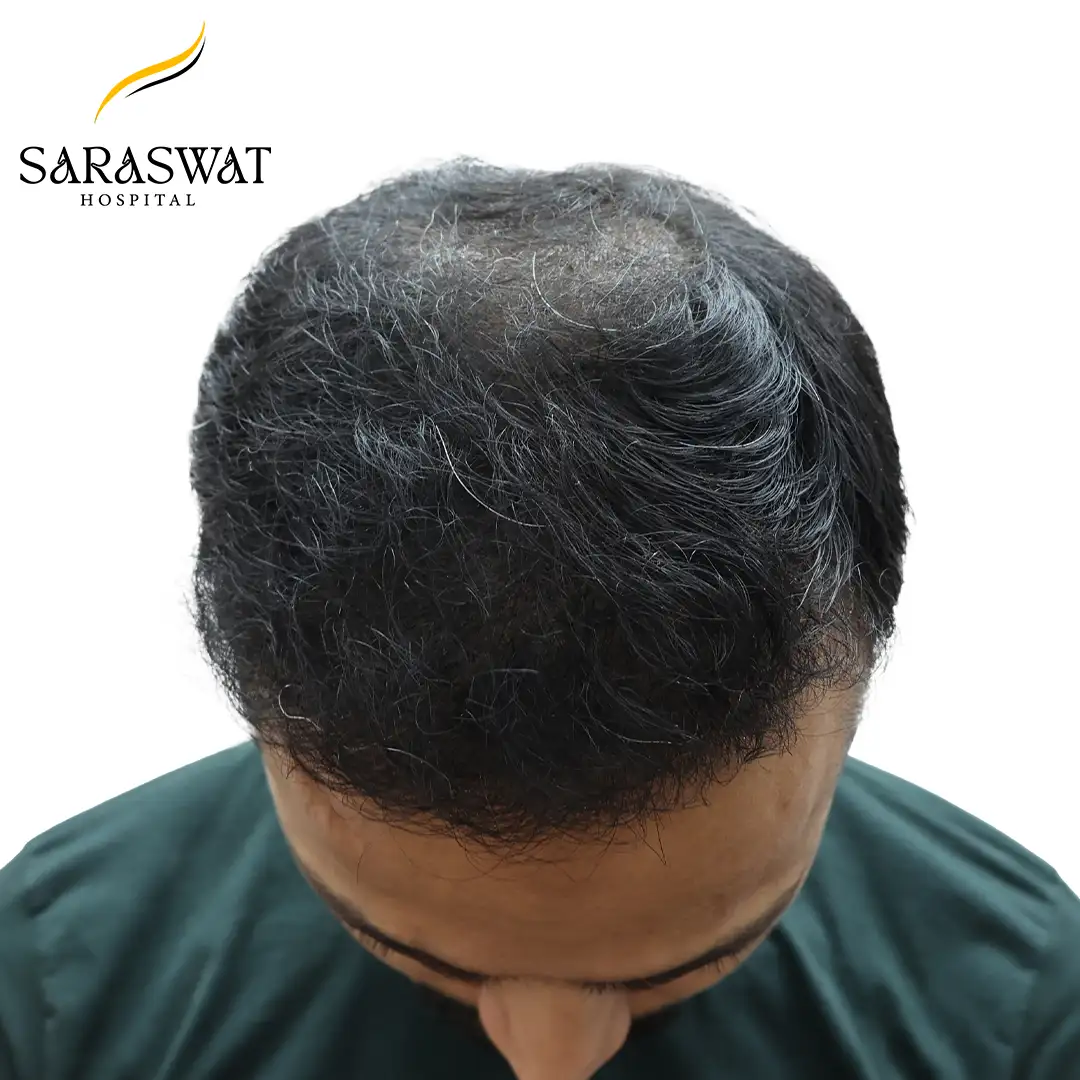 Hair Transplant Result
