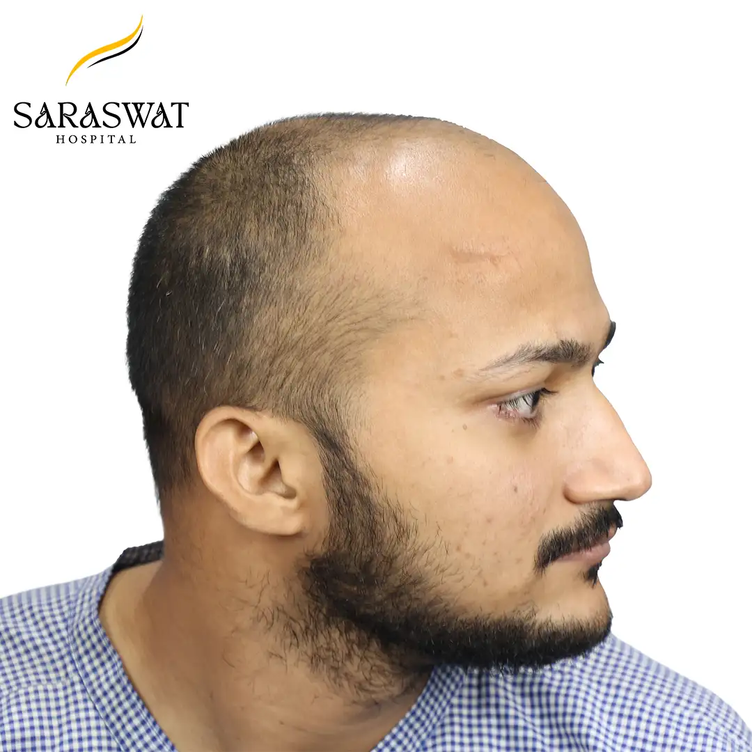 Hair Transplant Before and After