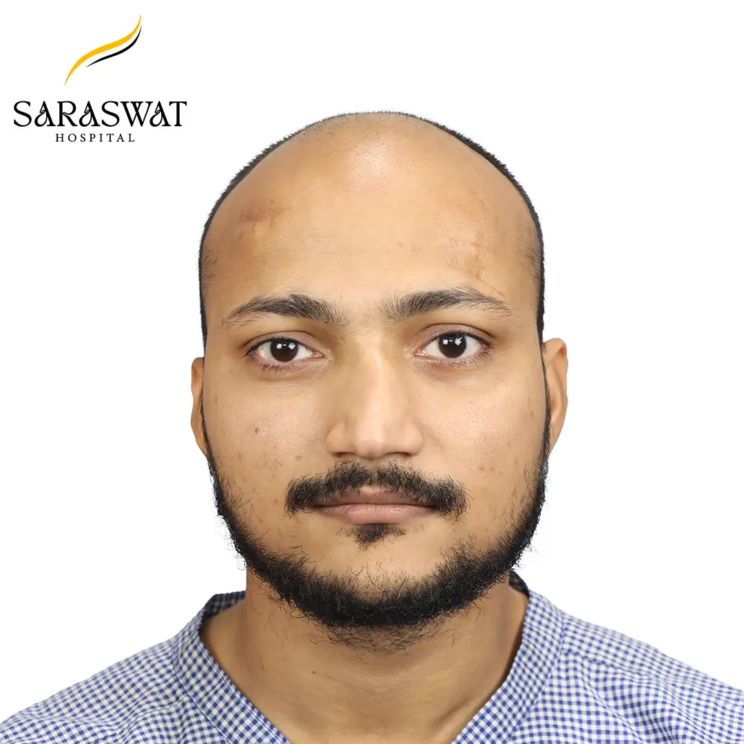 Hair Transplant Result