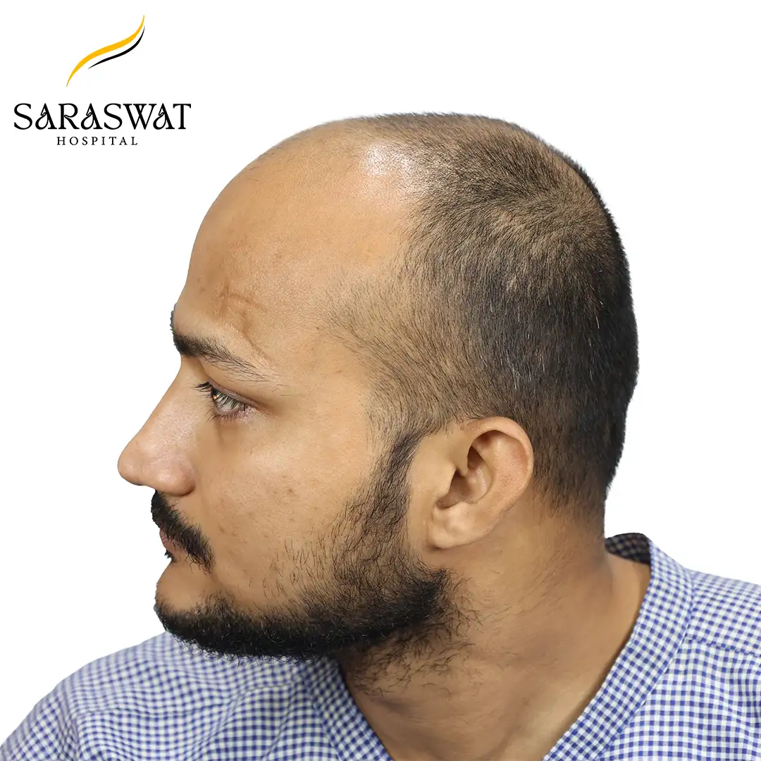 Hair Transplant Before and After