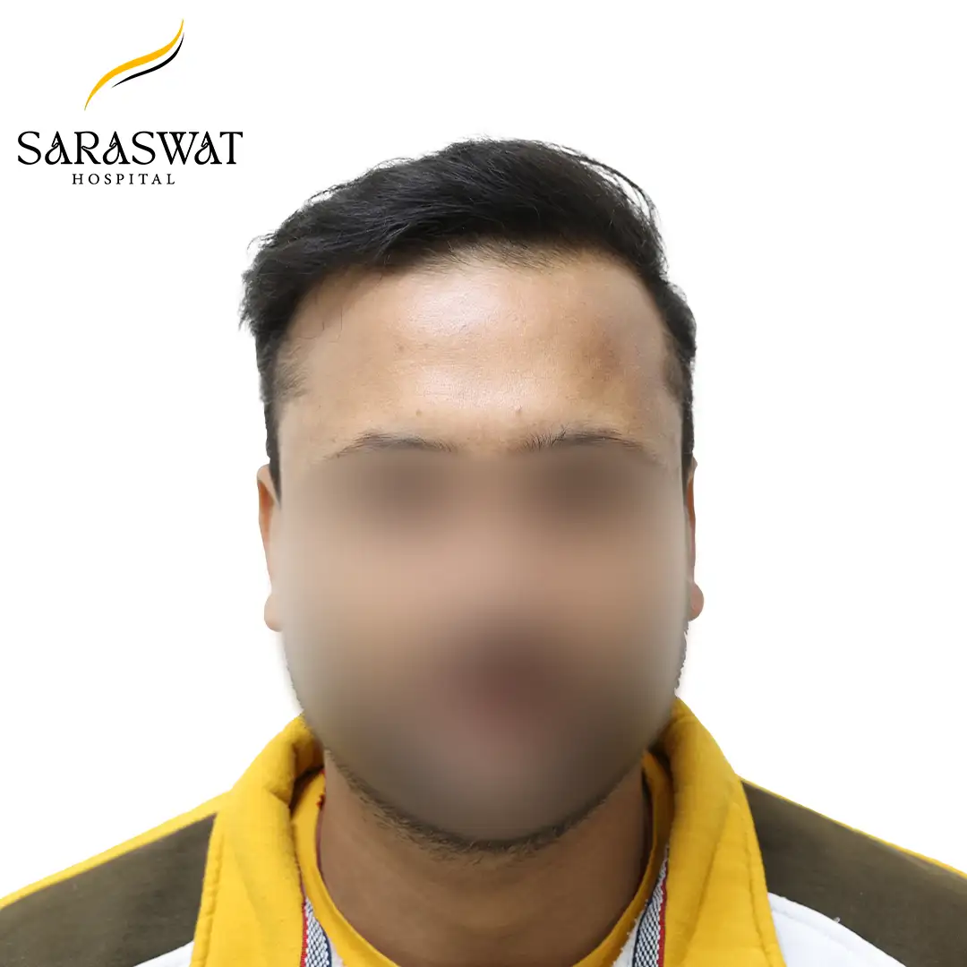 Front FUE Hair Transplant Result After Procedure