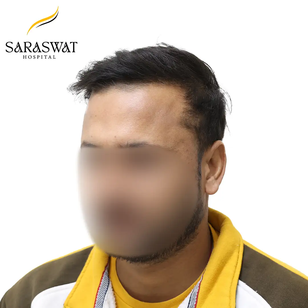 45 Degree Left FUE Hair Transplant Result After Procedure