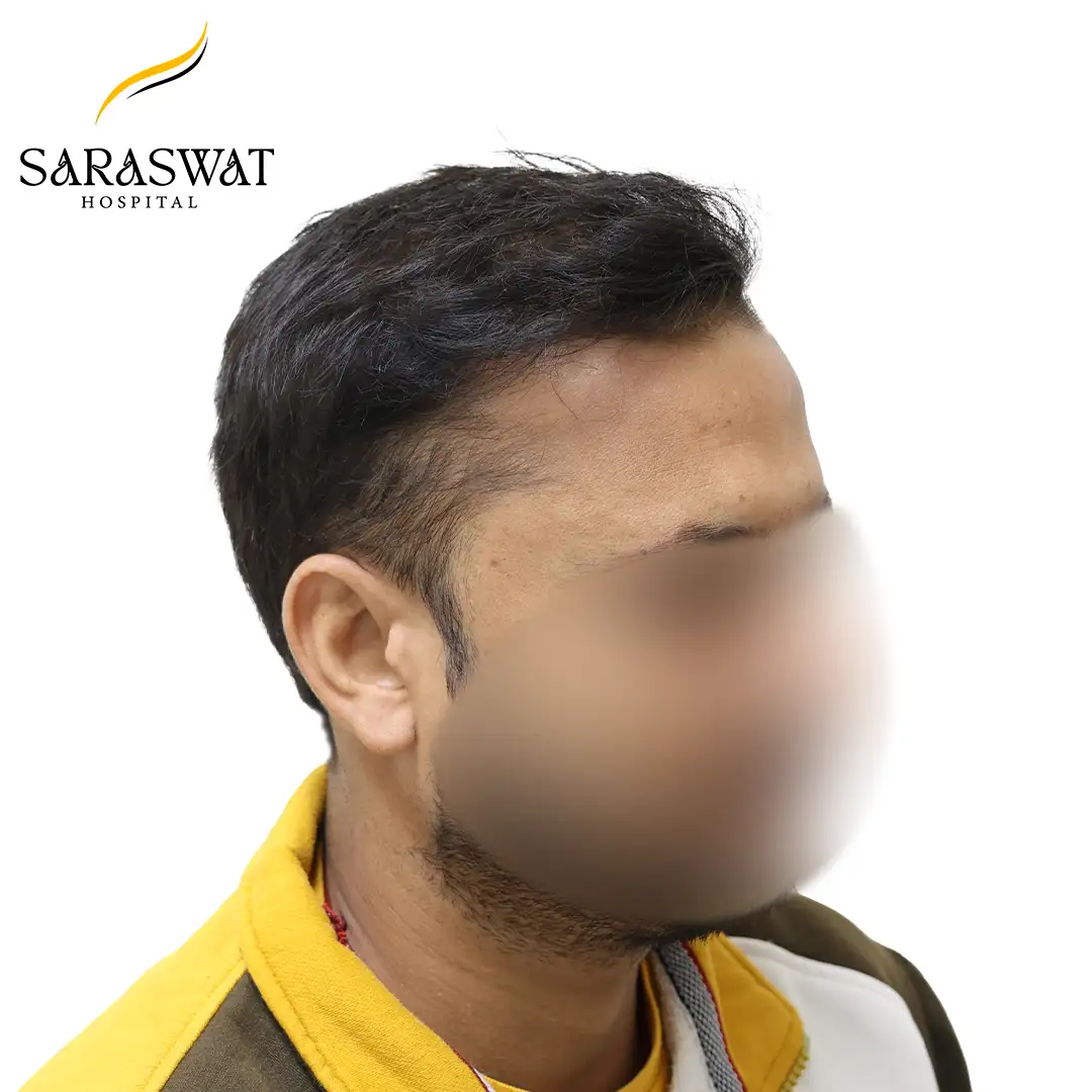 90 Degree Right FUE Hair Transplant Result After Procedure