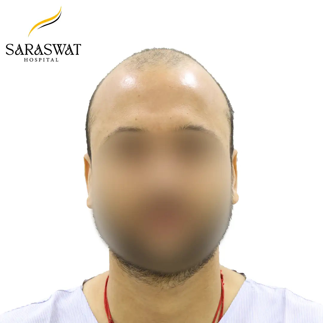 Front FUE Hair Transplant Result Before Procedure