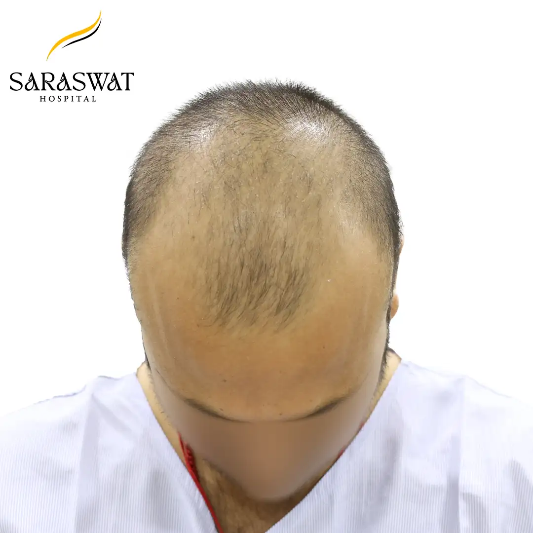 Top FUE Hair Transplant Result Before Procedure
