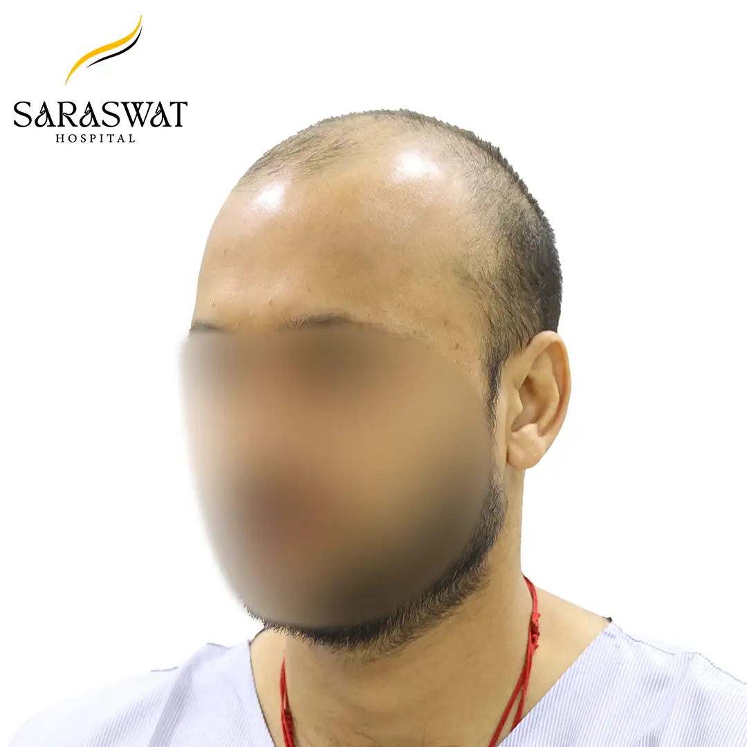 45 Degree Left FUE Hair Transplant Result Before Procedure