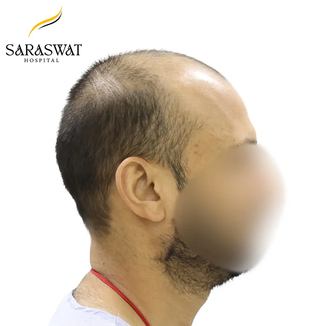 90 Degree Right FUE Hair Transplant Result Before Procedure