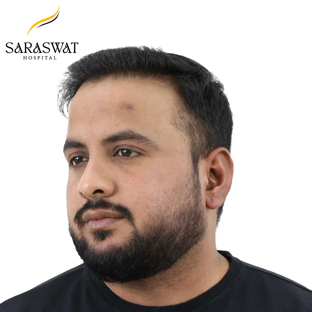 FUE Hair Transplant