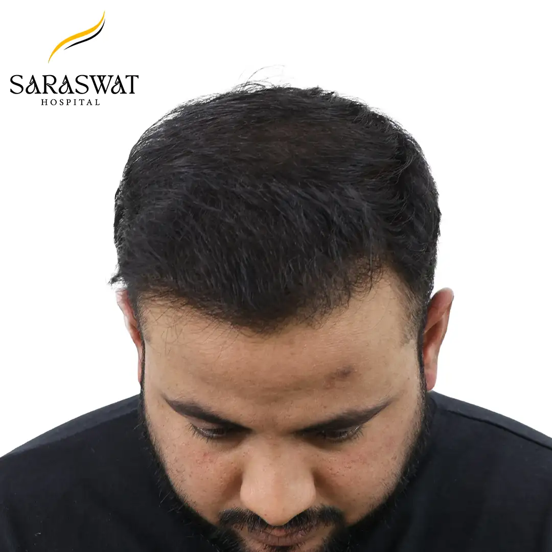 Hair Transplant After Result