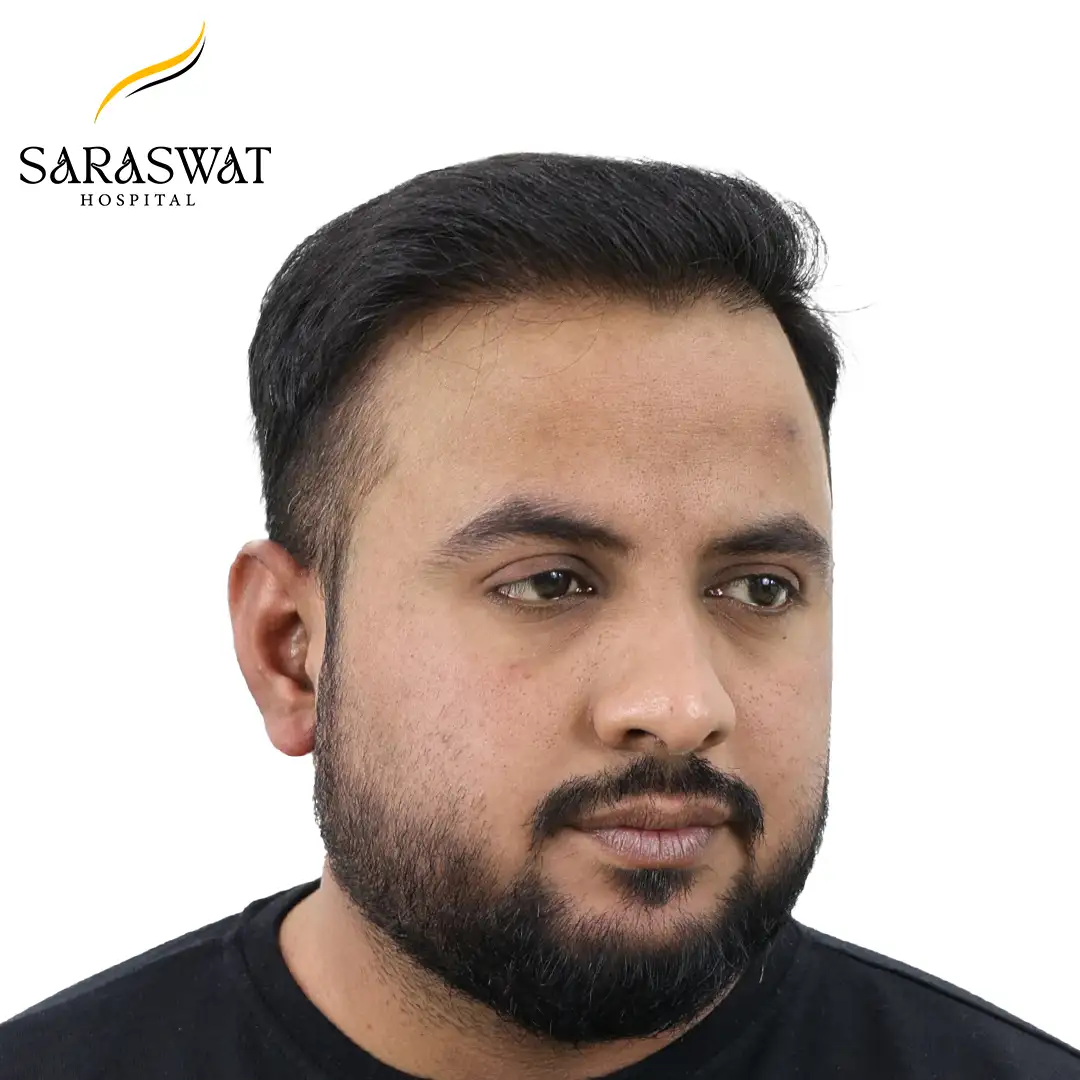 Hair Transplant Before and After