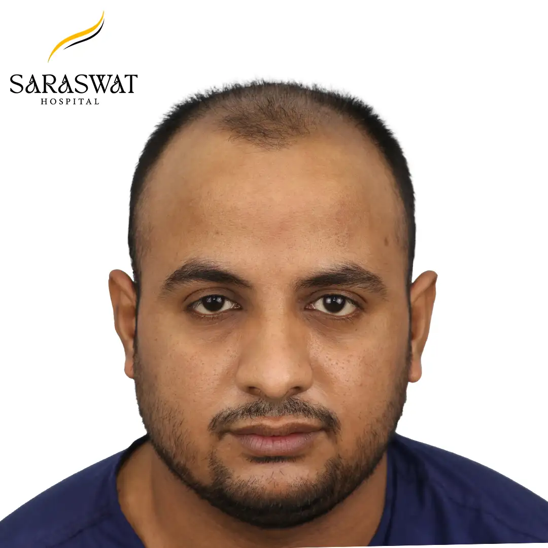 Hair Transplant Before Result