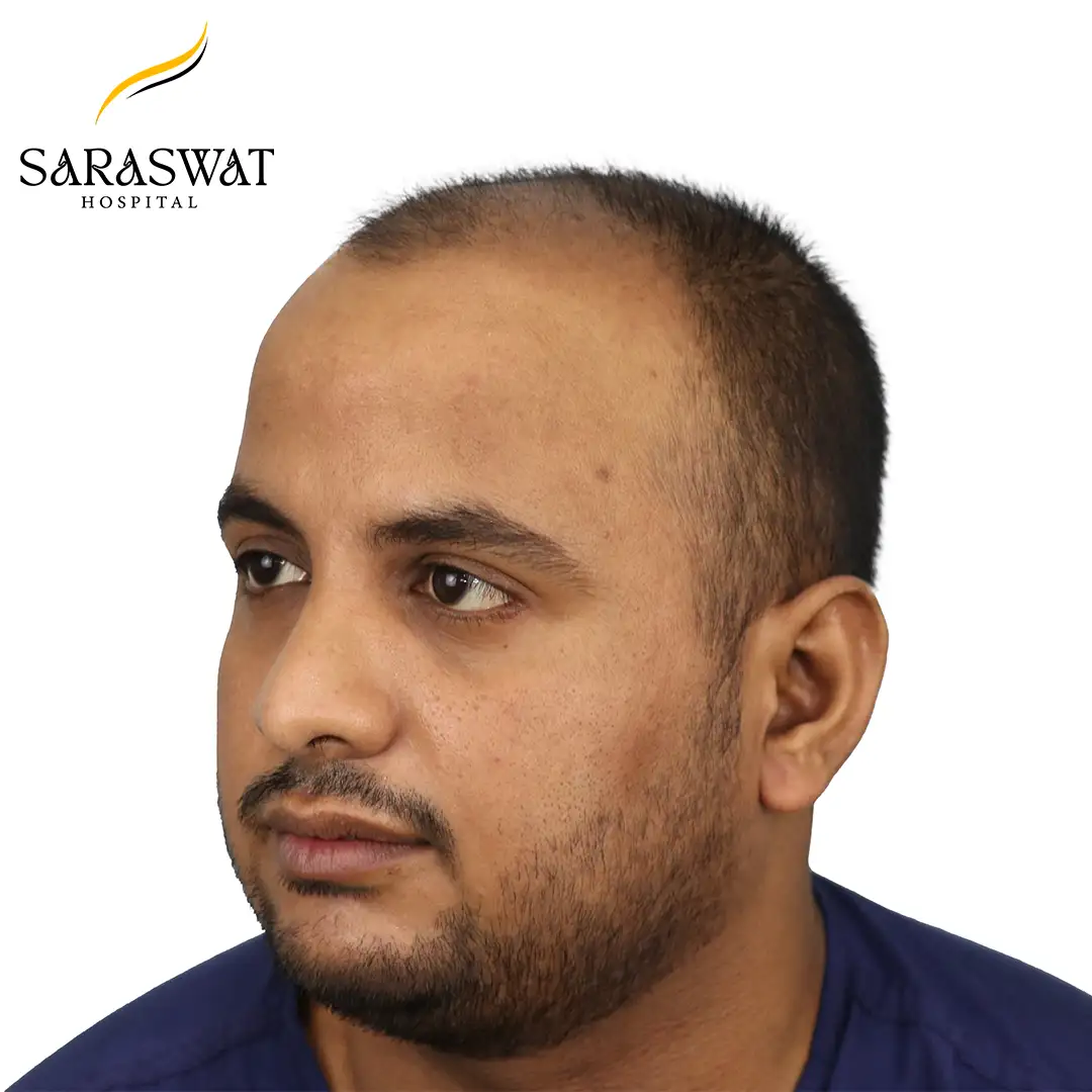 Hair Transplant Before Result