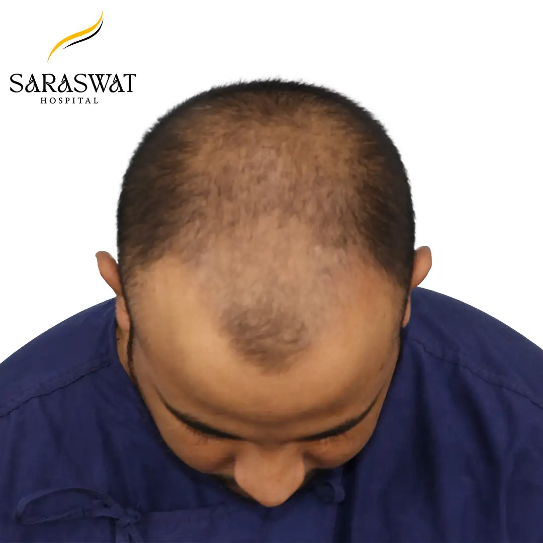 Hair Transplant Before Result