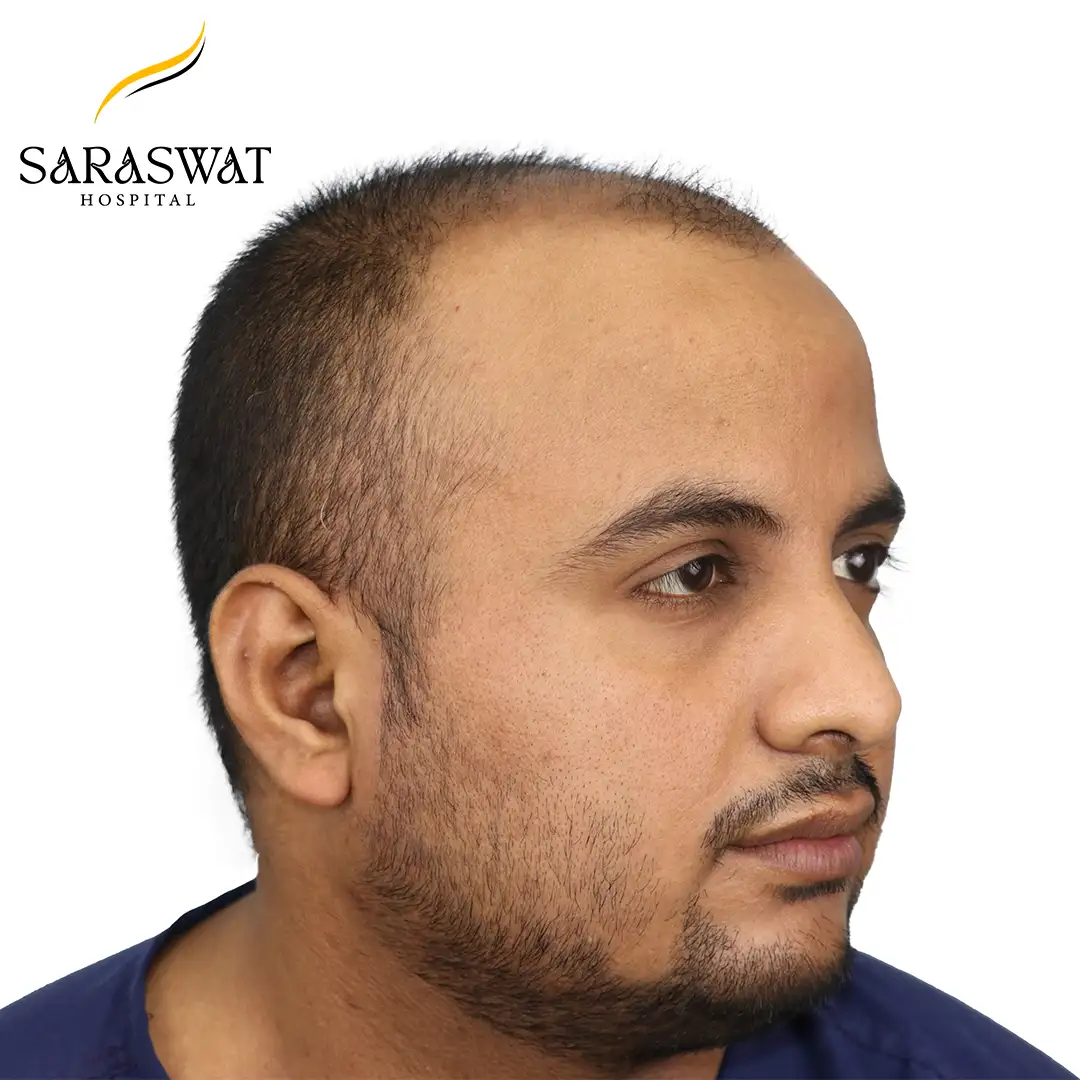 Hair Transplant Before Result