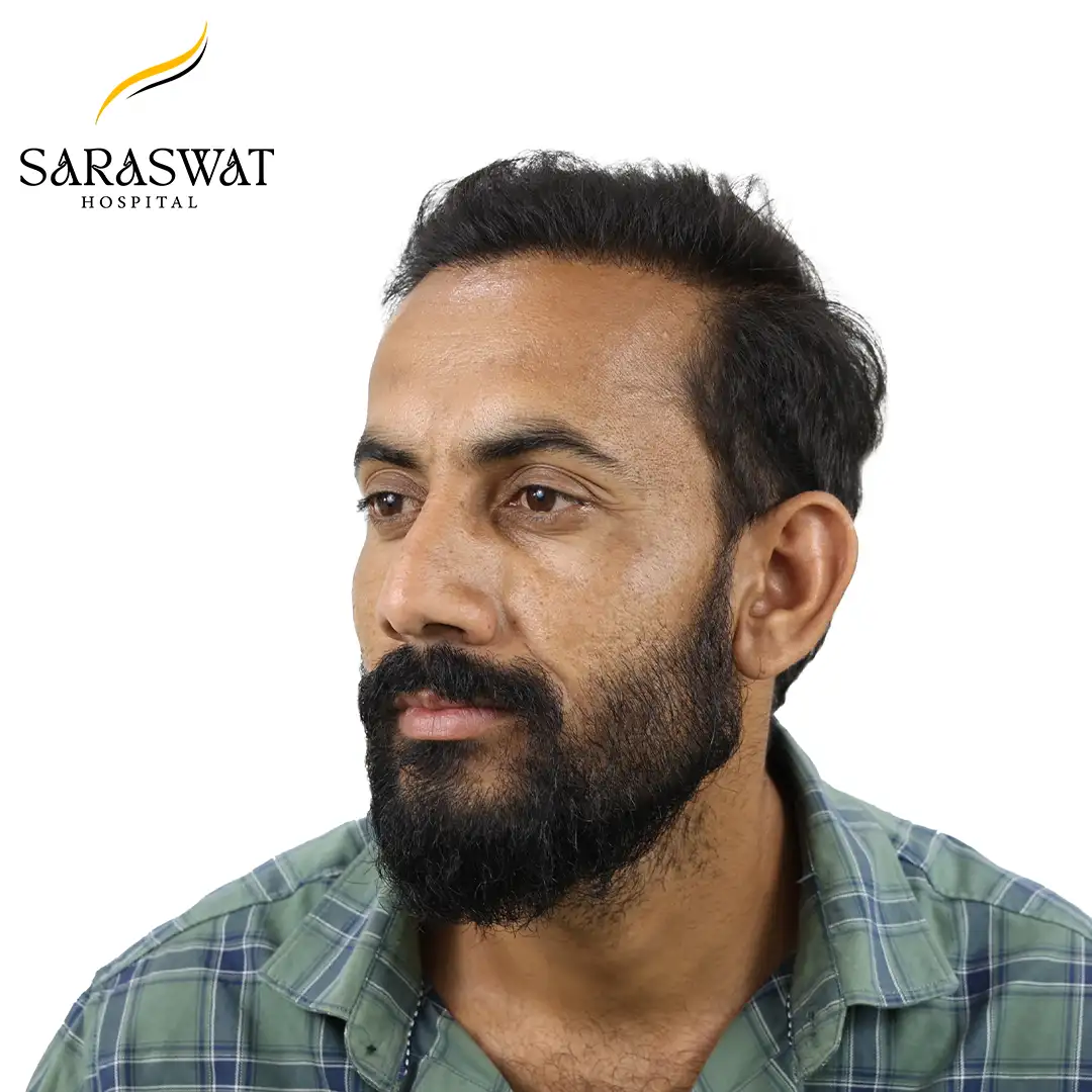 45 Degree Left FUE Hair Transplant Result After Procedure