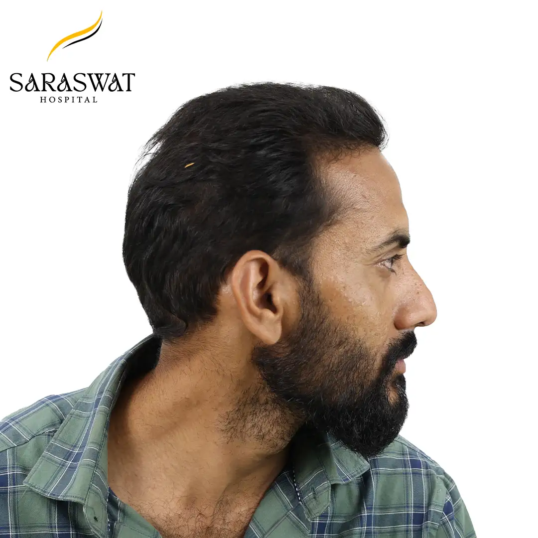 90 Degree Right FUE Hair Transplant Result After Procedure