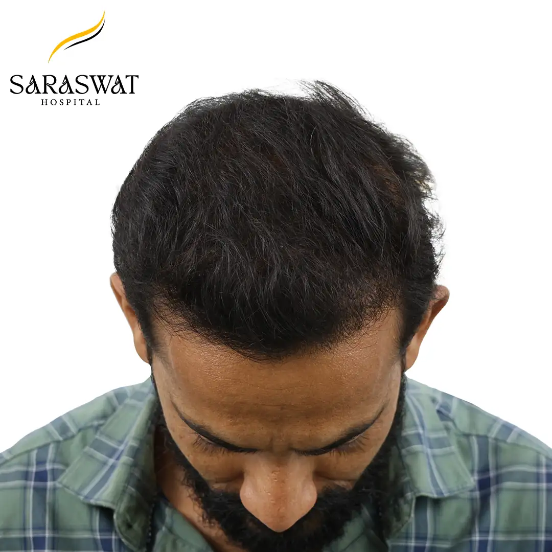 Top FUE Hair Transplant Result After Procedure