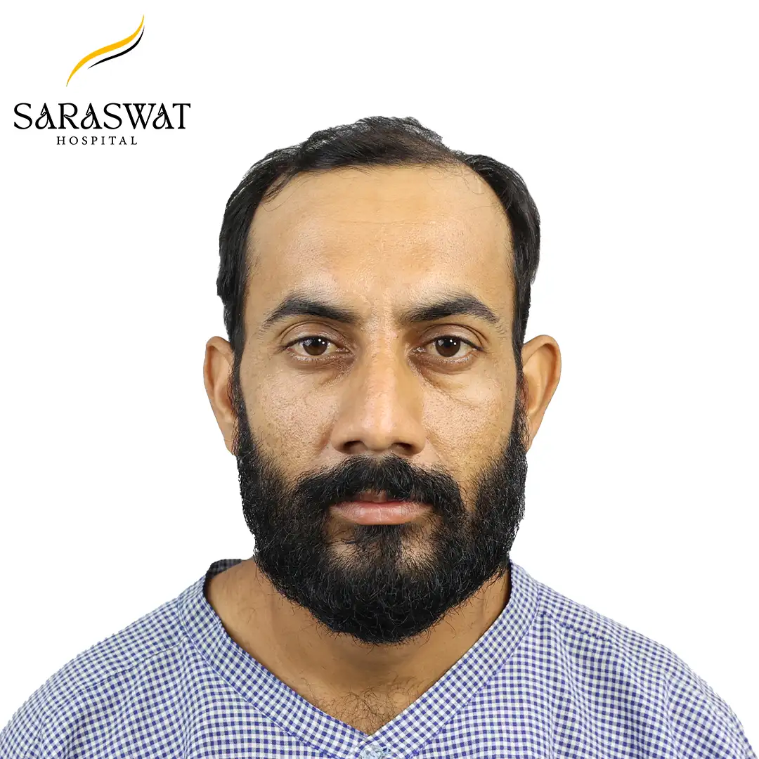 Hair Transplant Before and After Results