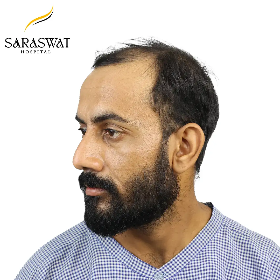 45 Degree Left FUE Hair Transplant Result Before Procedure