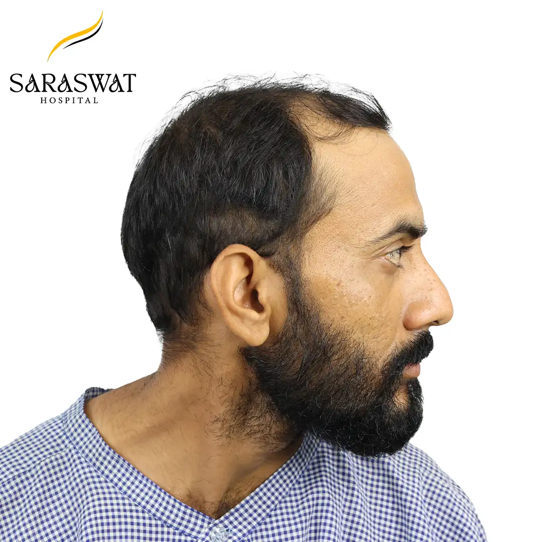 90 Degree Right FUE Hair Transplant Result Before Procedure