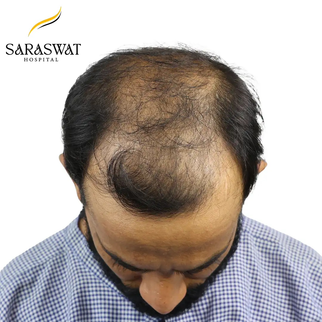 Top FUE Hair Transplant Result Before Procedure