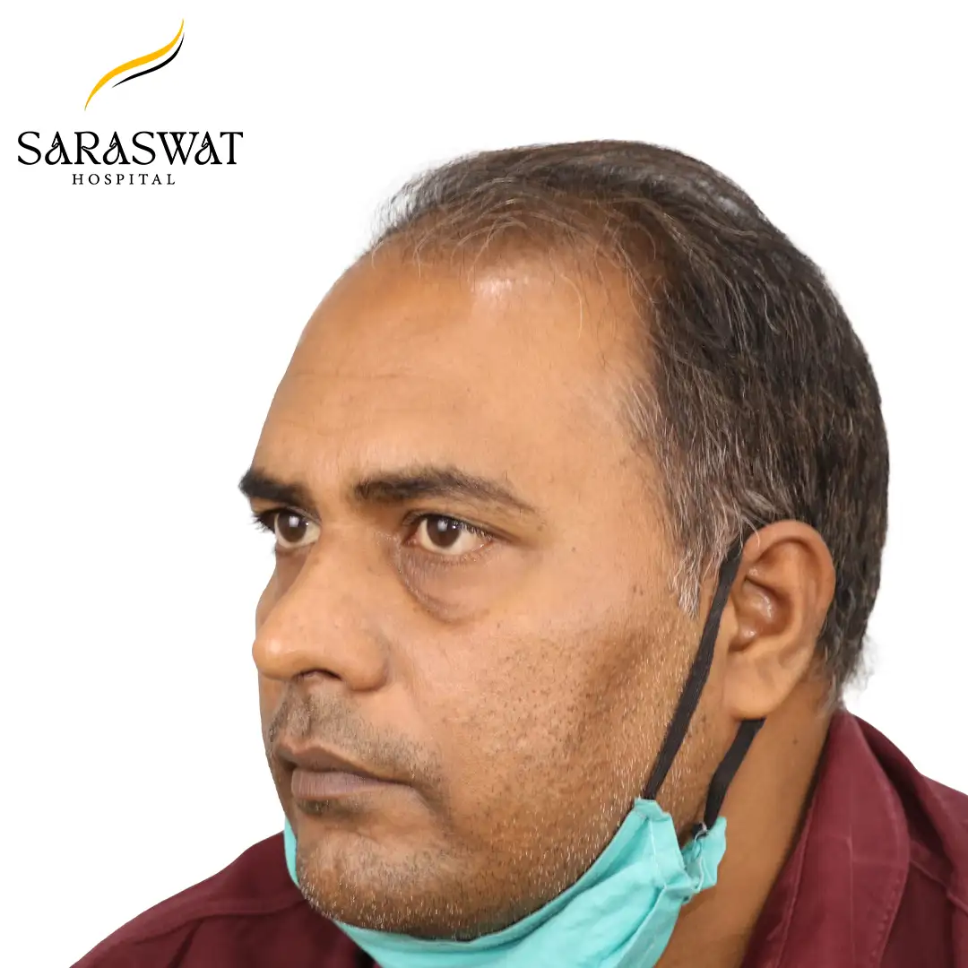 Hair Transplant Before Results