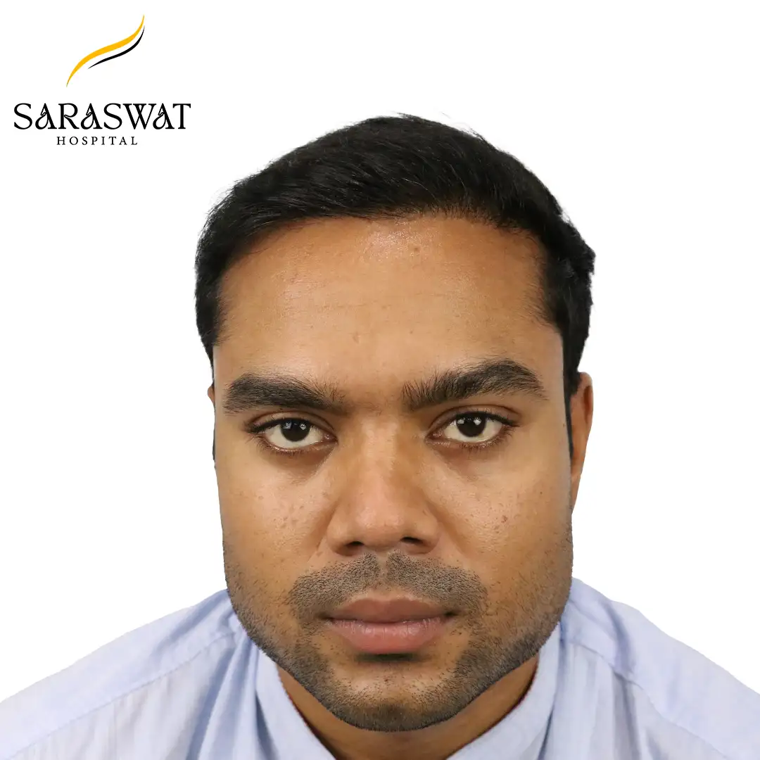 Front FUE Hair Transplant Result After Procedure