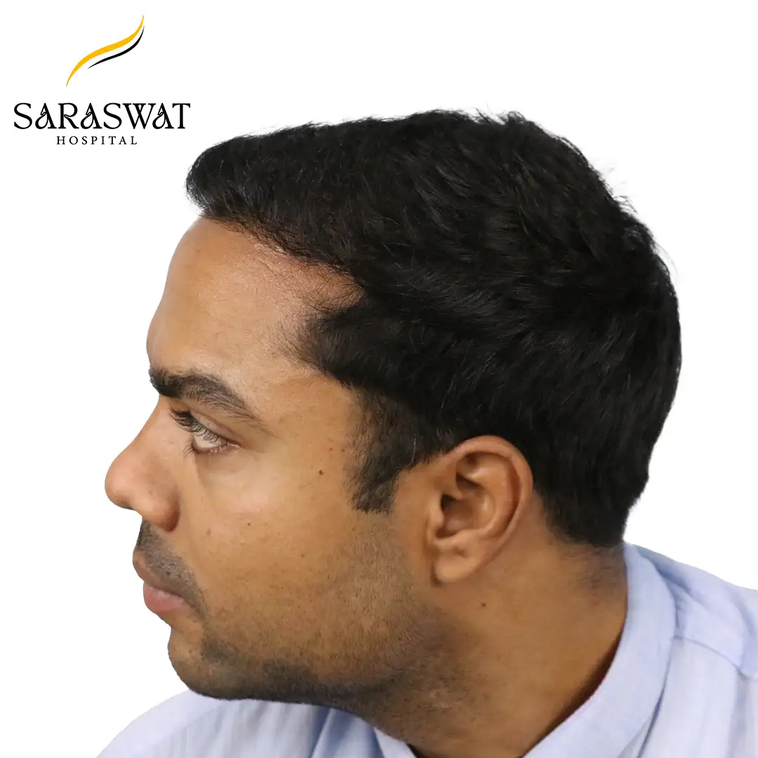 90 Degree Left FUE Hair Transplant Result After Procedure