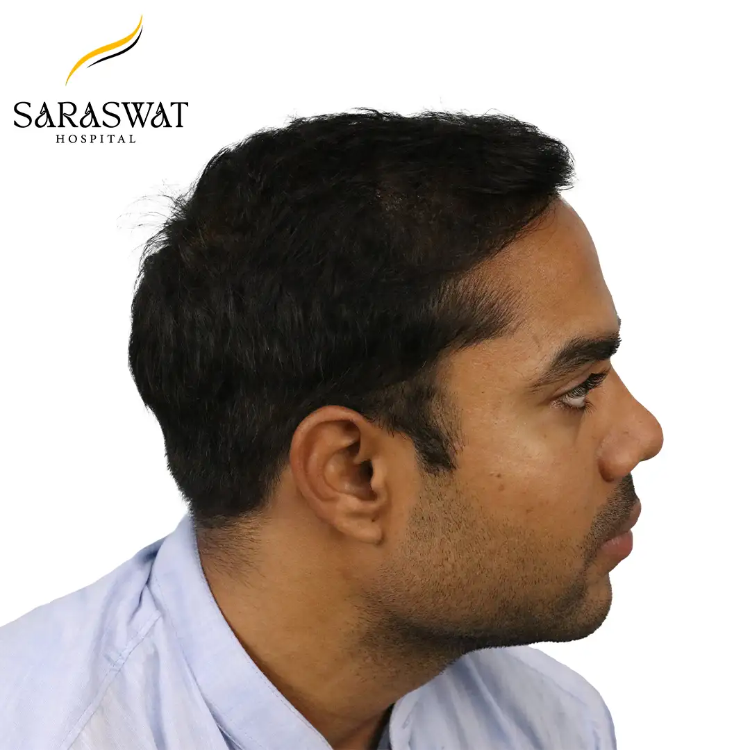 Hair Transplant After Result