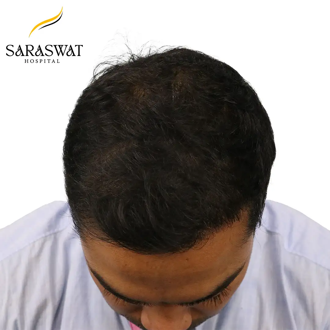 Top FUE Hair Transplant Result After Procedure