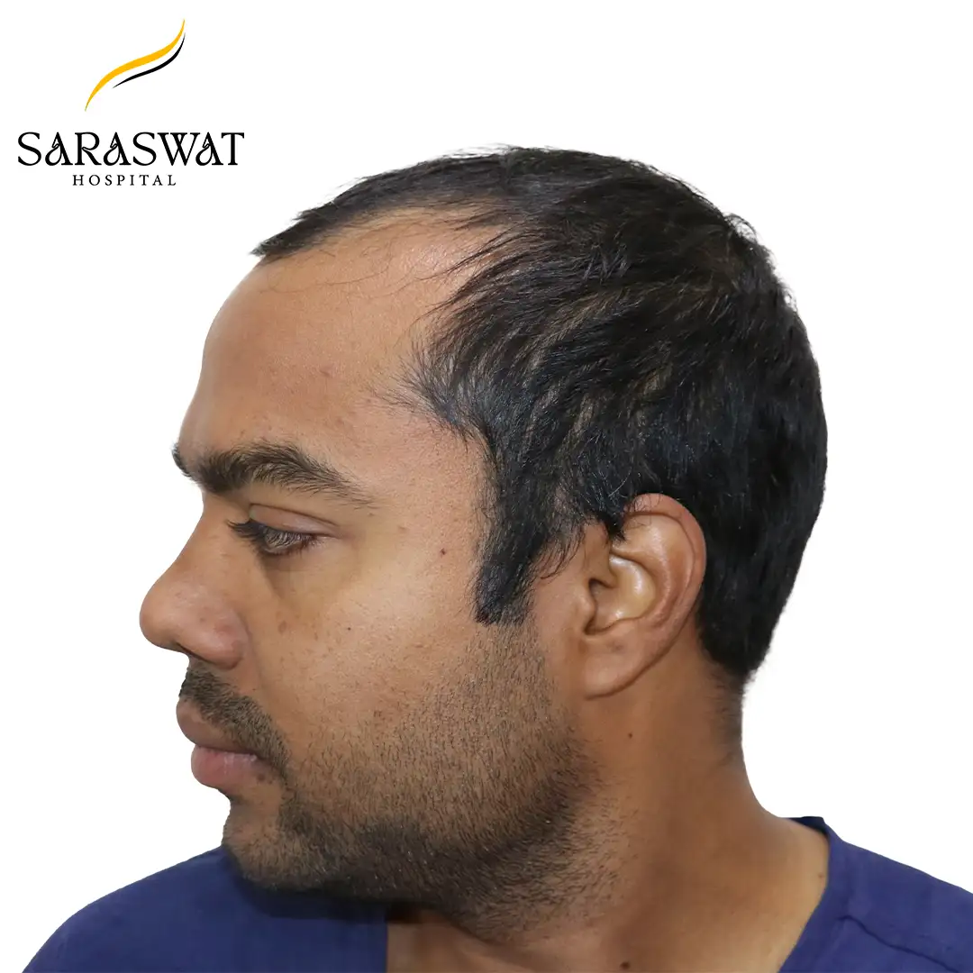 90 Degree Left FUE Hair Transplant Result Before Procedure