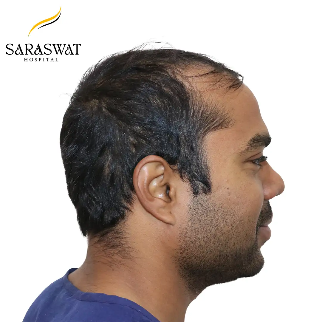Hair Transplant Before Result