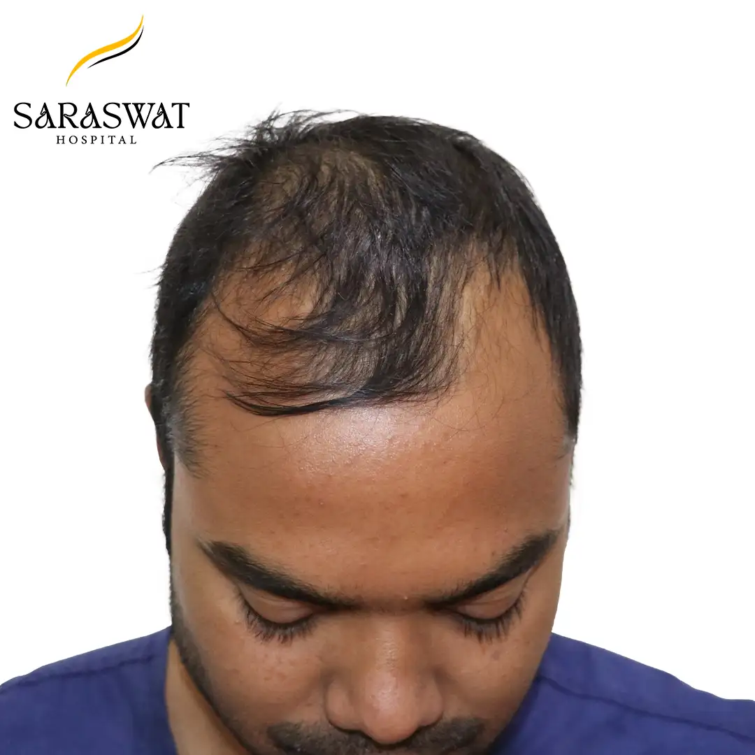 Top FUE Hair Transplant Result Before Procedure