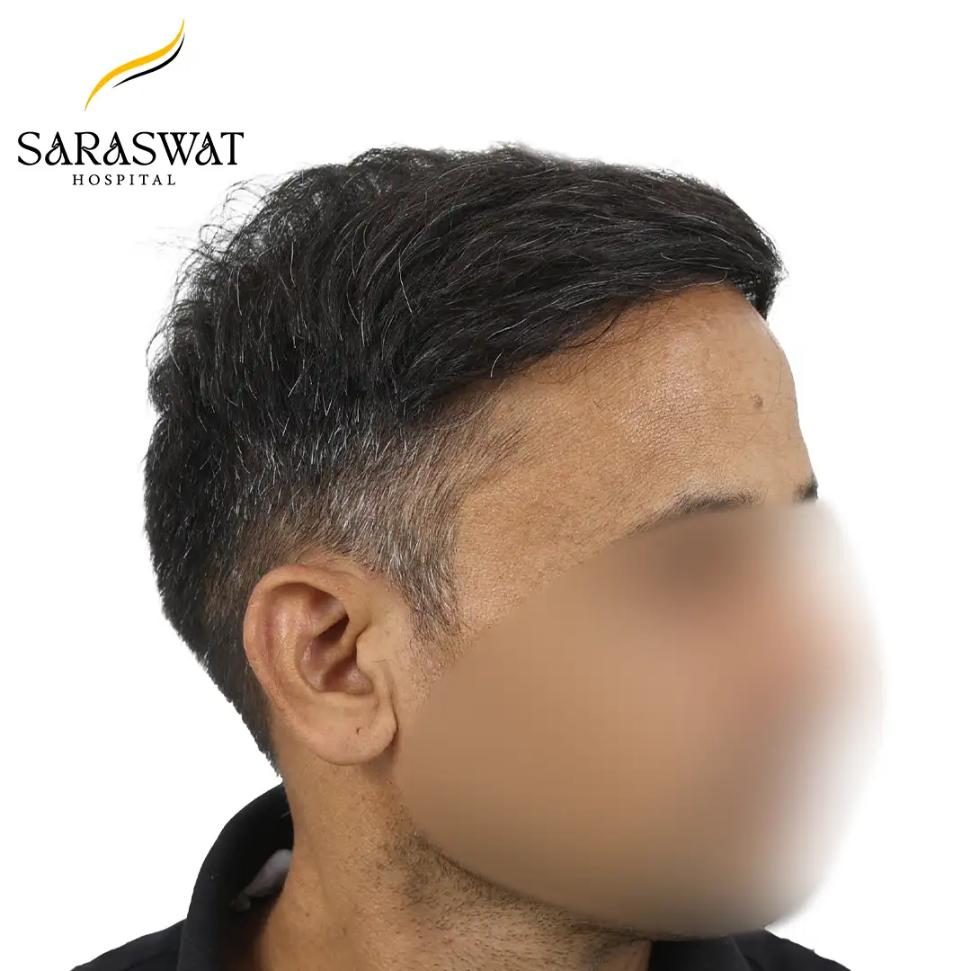90 Degree Right FUE Hair Transplant Result After Procedure