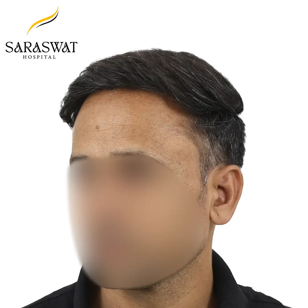 45 Degree Left FUE Hair Transplant Result After Procedure